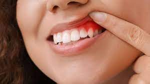 What Do You Need To Know About Gum Recession?